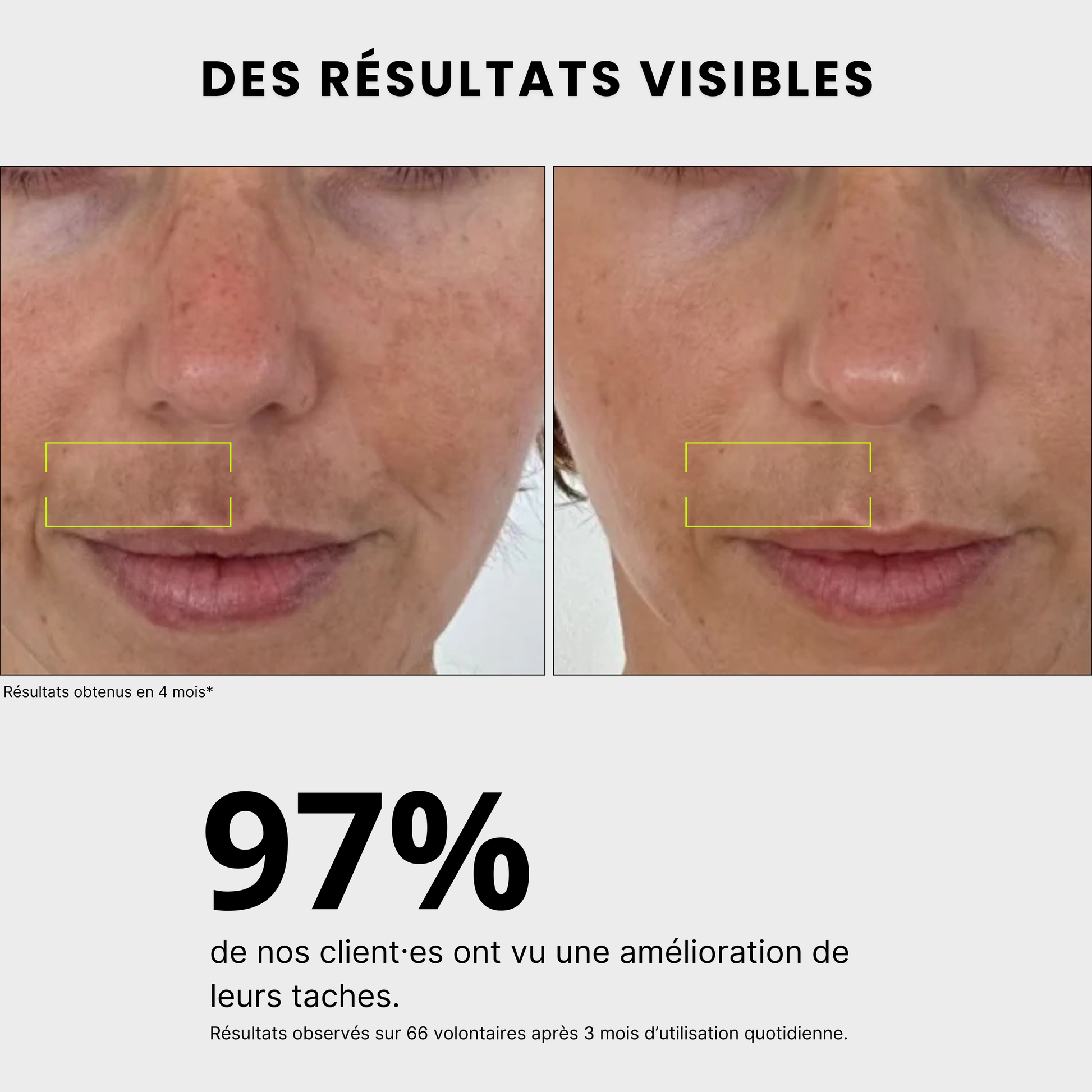 résultats visibles Routine anti-taches anti imprefection pour traiter l'acné, exces de sebum, cicatrices post-inflammatoire, tache solaire, melasma, hormonale, à l'acide kojique, curcuma, curcumine et niacinamide, vitamine B5, AHA et PHA Jeu De Peau