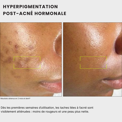 avant après Routine anti-taches anti imprefection pour traiter l'acné, exces de sebum, cicatrices post-inflammatoire, tache post-acné, tache solaire, melasma, hormonale, à l'acide kojique, curcuma, curcumine et niacinamide, vitamine B5, AHA et PHA Jeu De Peau