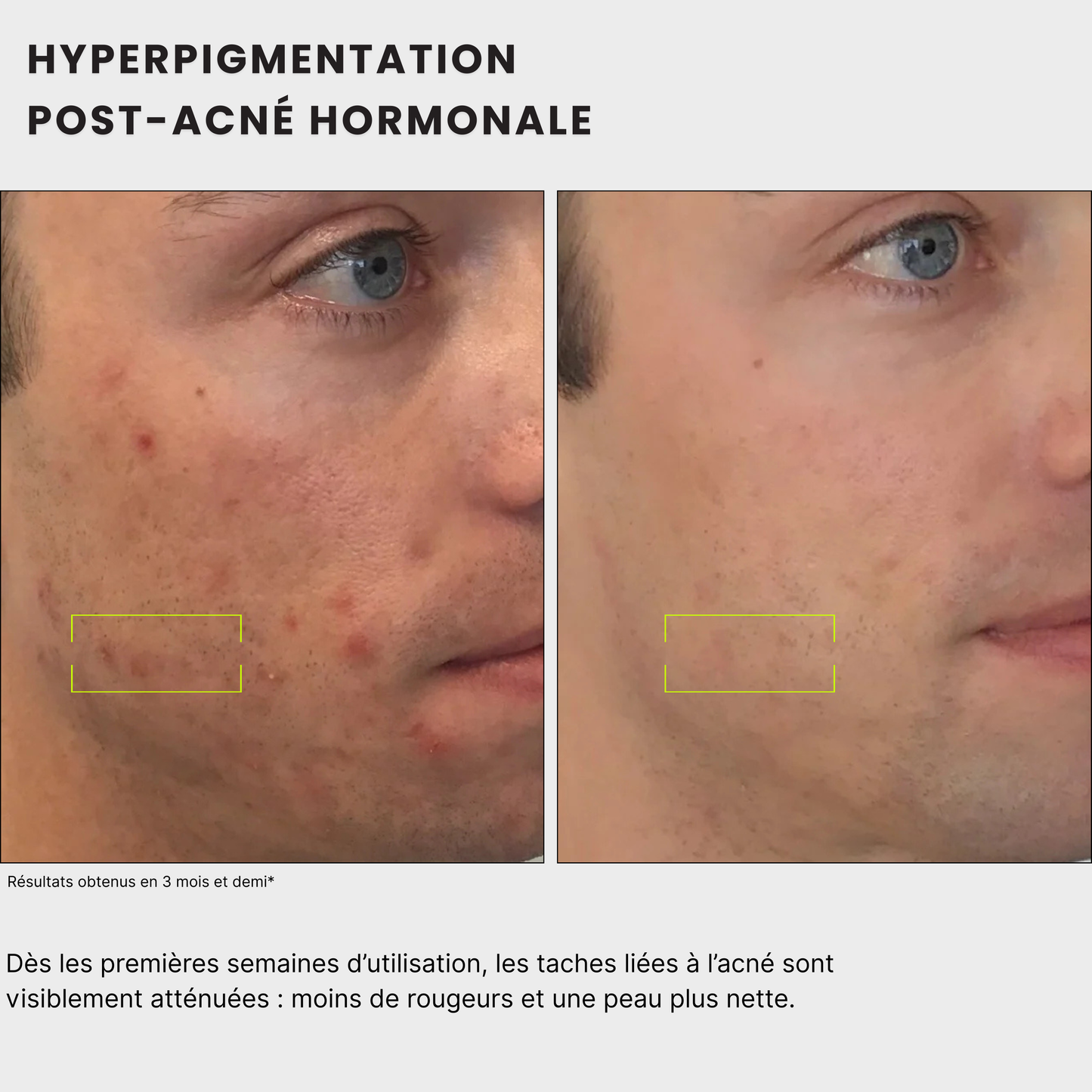 avant après pour homme et femme Routine anti-taches anti imprefection pour traiter l'acné, exces de sebum, cicatrices post-inflammatoire, tache post-acné, tache solaire, melasma, hormonale, à l'acide kojique, curcuma, curcumine et niacinamide, vitamine B5, AHA et PHA Jeu De Peau