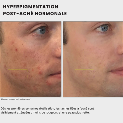 avant après pour homme et femme Routine anti-taches anti imprefection pour traiter l'acné, exces de sebum, cicatrices post-inflammatoire, tache post-acné, tache solaire, melasma, hormonale, à l'acide kojique, curcuma, curcumine et niacinamide, vitamine B5, AHA et PHA Jeu De Peau