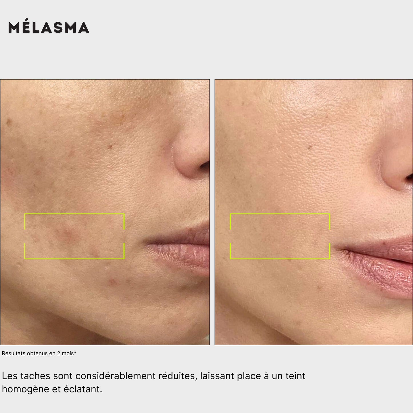 avant après pour homme et femme Routine anti-taches anti imprefection pour traiter l'acné, exces de sebum, cicatrices post-inflammatoire, tache post-acné, tache solaire, melasma, hormonale, à l'acide kojique, curcuma, curcumine et niacinamide, vitamine B5, AHA et PHA Jeu De Peau