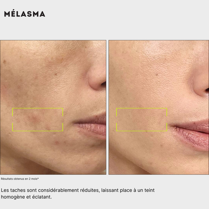 avant après pour homme et femme Routine anti-taches anti imprefection pour traiter l'acné, exces de sebum, cicatrices post-inflammatoire, tache post-acné, tache solaire, melasma, hormonale, à l'acide kojique, curcuma, curcumine et niacinamide, vitamine B5, AHA et PHA Jeu De Peau