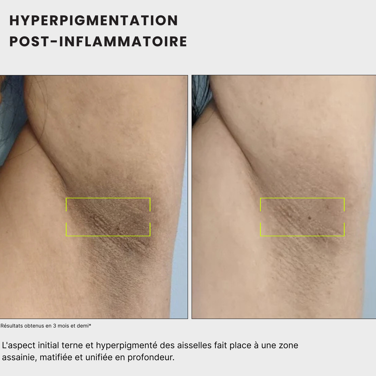 avant après pour homme et femme Routine anti-taches anti imprefection pour traiter les taches noires sous les aisselles, à l'acide kojique, curcuma, curcumine et niacinamide, vitamine B5, AHA et PHA Jeu De Peau