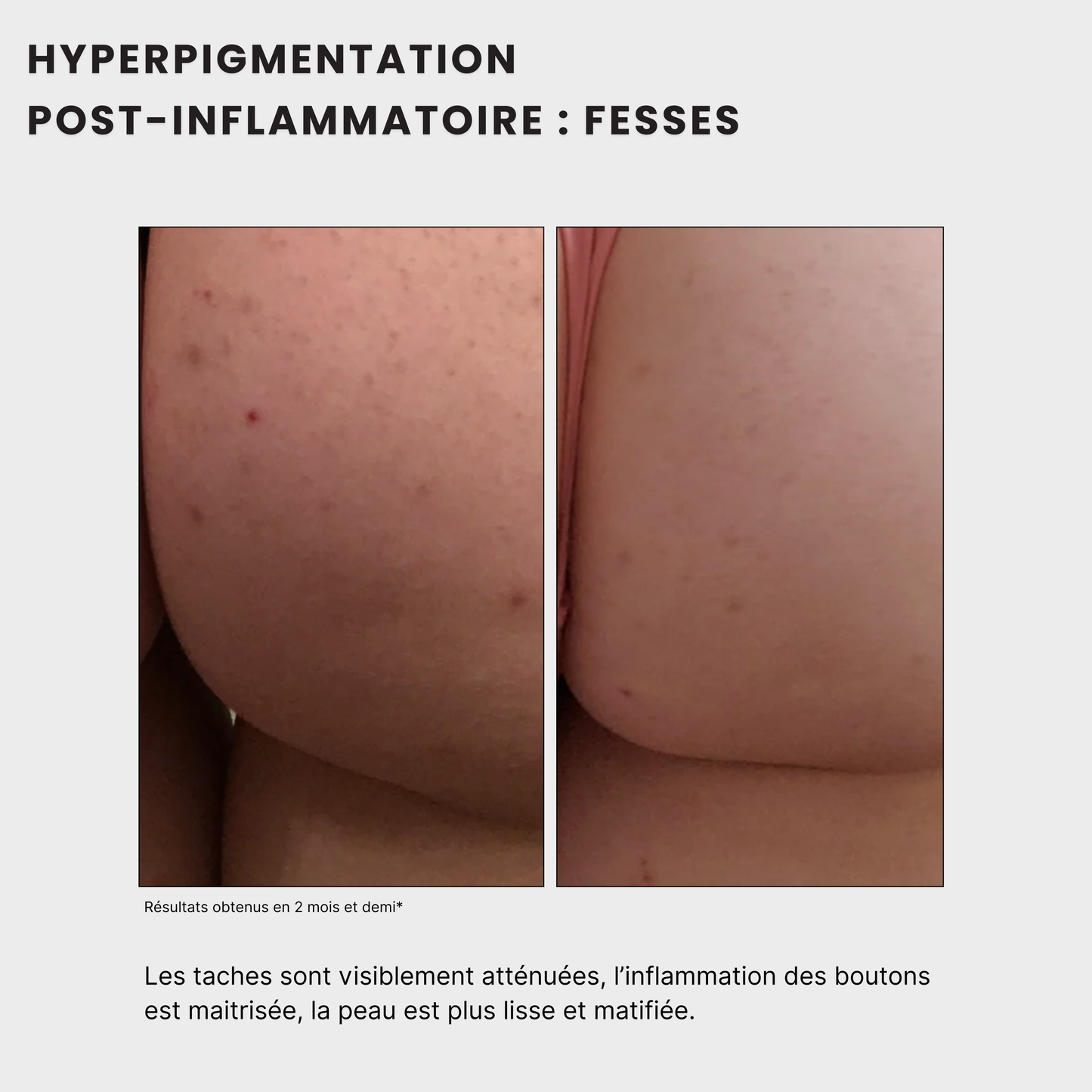 avant après pour homme et femme Routine anti-taches anti imprefection pour traiter les taches post- acné, tache sur les fesses, les coudes, les aisselle , le maillot, à l'acide kojique, curcuma, curcumine et niacinamide, vitamine B5, AHA et PHA Jeu De Peau