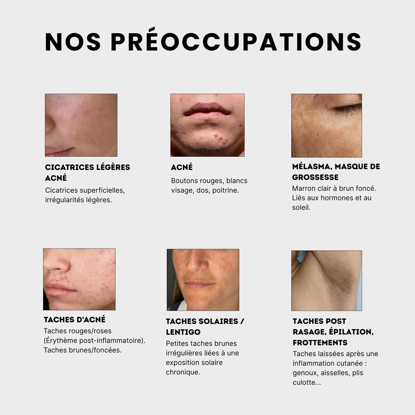  le soin anti-taches anti imprefection pour traiter les taches post- acné, les cicatrices legeres d'acné, l'acné, le mélasma et masque de grossesse, les taches solaires, lentigo, les taches post rasage, epilation et frottements ur les fesses, les coudes, genoux, les aisselle , le plis culotte, à l'acide kojique, curcuma, curcumine et niacinamide, vitamine B5, AHA et PHA Jeu De Peau