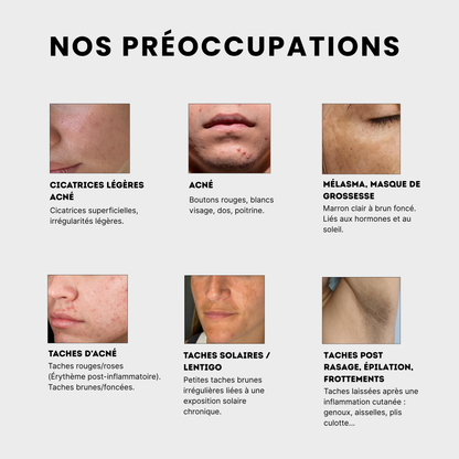  le soin anti-taches anti imprefection pour traiter les taches post- acné, les cicatrices legeres d'acné, l'acné, le mélasma et masque de grossesse, les taches solaires, lentigo, les taches post rasage, epilation et frottements ur les fesses, les coudes, genoux, les aisselle , le plis culotte, à l'acide kojique, curcuma, curcumine et niacinamide, vitamine B5, AHA et PHA Jeu De Peau